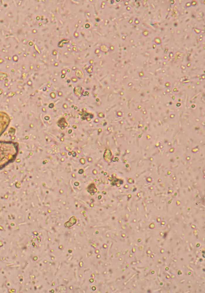 Giardia vitamin deficiency - Giardia tratament naturist pentru copii