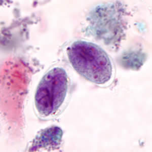 giardiasis kép)