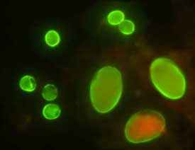 giardiasis aura)