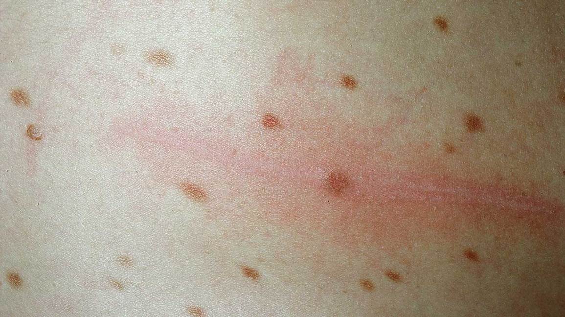 pinworms és urticaria)
