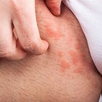 pinworms és urticaria
