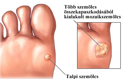 a nemi szemölcsök utáni sebgyógyulásra)