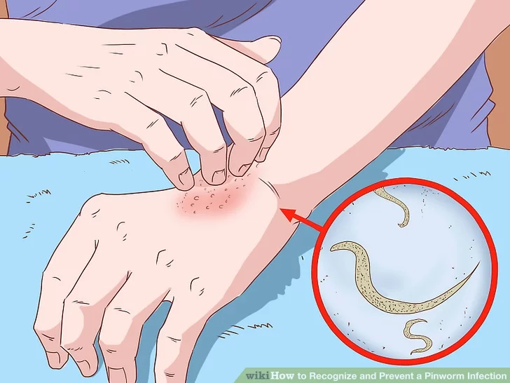 a pinworms ellen melyik a jobb