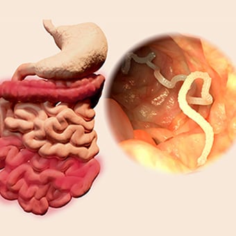 pinworms kezelés és tünetek