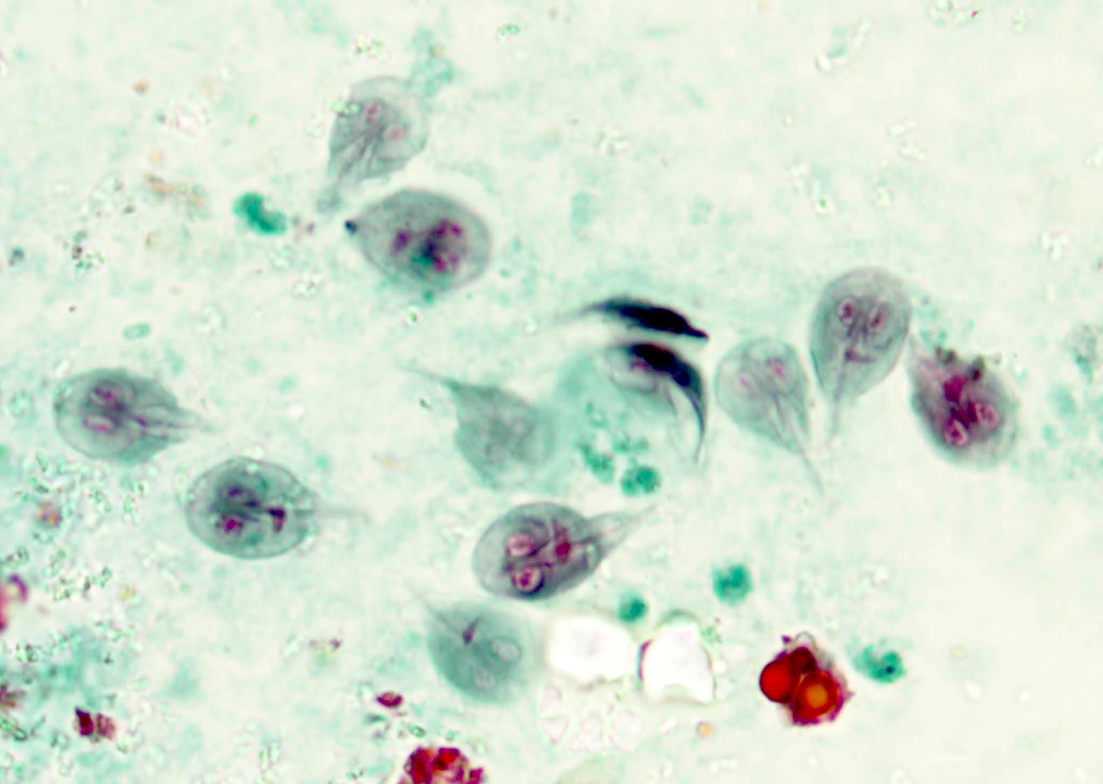 a giardiasis tünetei fénykép paraziták lábfekélyei