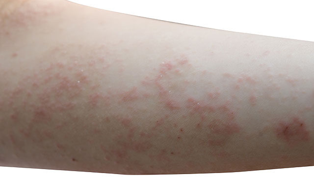 felnőttkori giardiasis tünetei hogyan lehet azonosítani