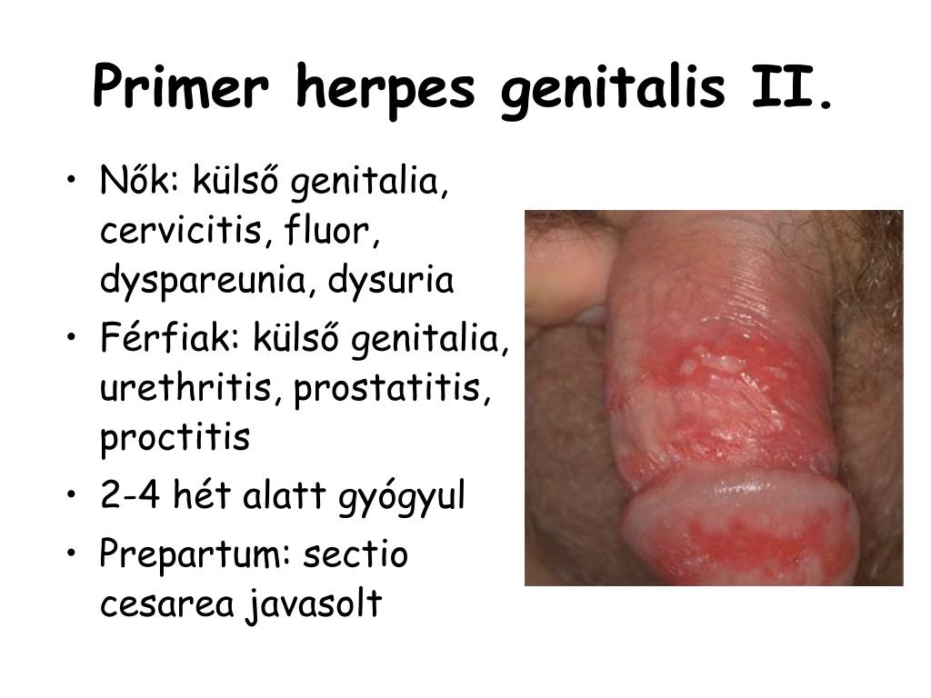 szemölcsök férfi nemi szerven