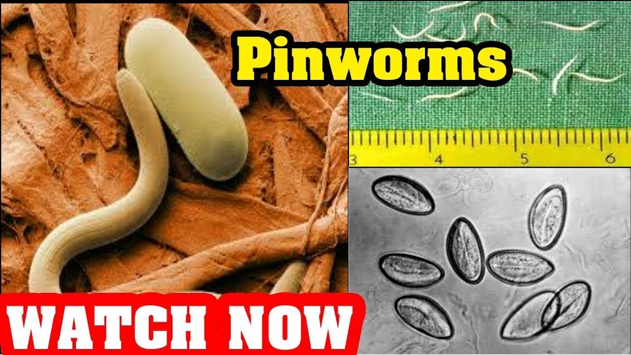 A pinworms paraziták az emberekben
