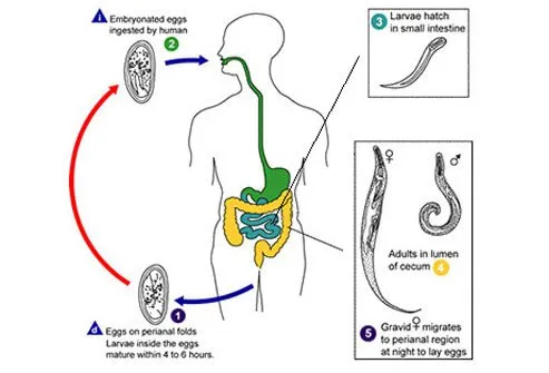 pinworms hatékony gyógyszer pinworms)