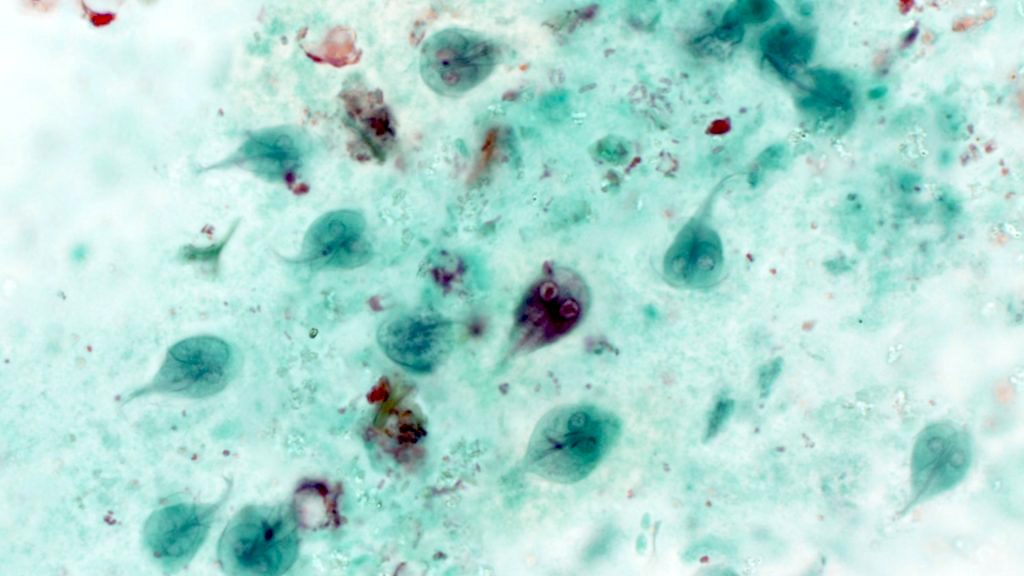 giardiasis pathology outlines