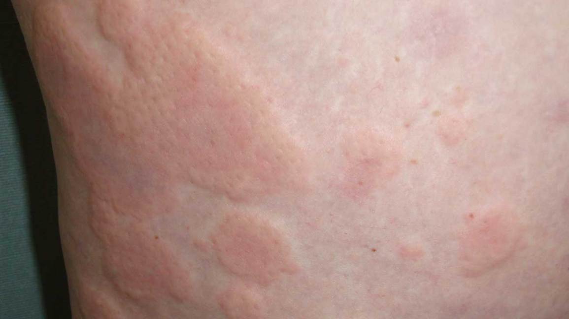 pinworms és urticaria