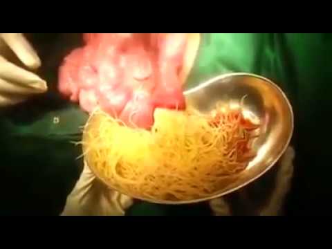 gömbféreg az orron keresztül)