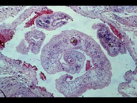 Ascaris kezelése felnőttnél - Ascaris emberi kezelés Az orsóférgesség okai, tünetei és kezelése
