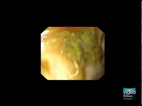 Pinworm a pinworms emberektől