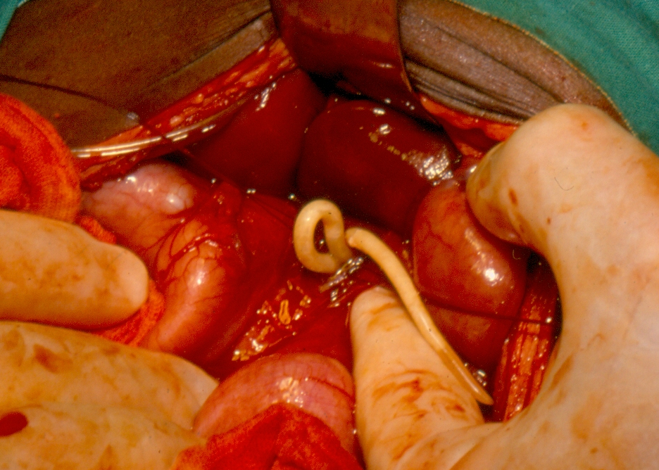 helminthiasis petesejtek