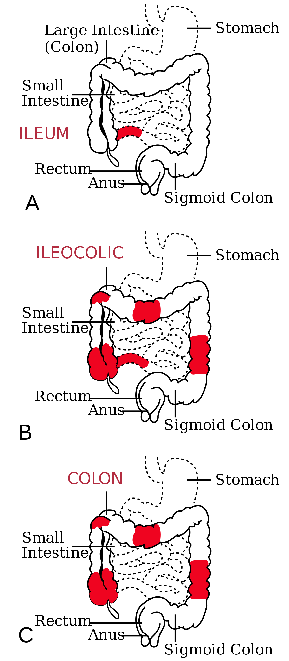 colitis ulcerosa bélféreg)