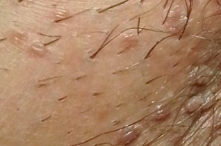 szemölcsök papilloma condyloma kezelés)